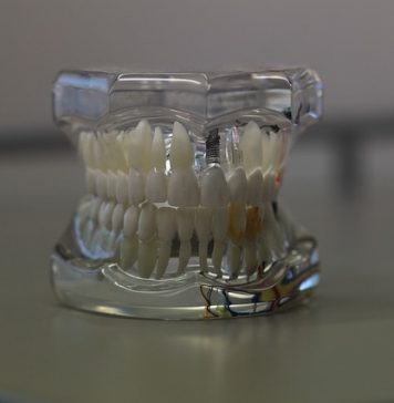 Implant dentar
