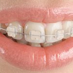 tipuri de aparate dentare