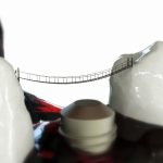 Implanturi-dentare-in-sector-3