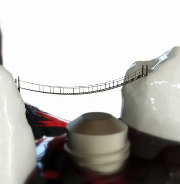 Mituri despre implanturi dentare Dental Crown Health