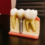 implant-dentar-în-Bucuresti