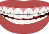 tratament Invisalign
