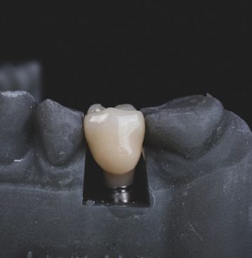 In ce situatii este contraindicat implantul dentar? implant dentar in Bucuresti