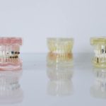 Proteza-pe-implant
